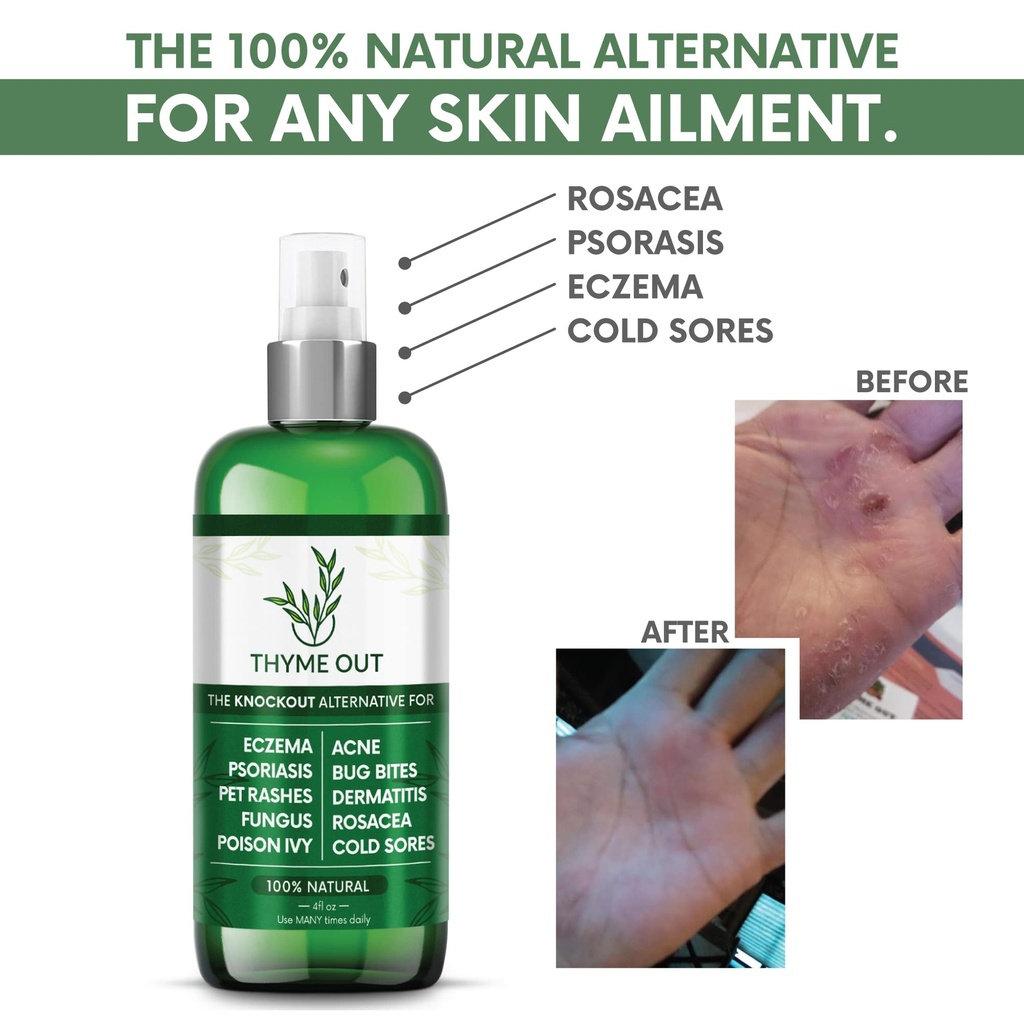 thyme-out-all-natural-eczema-treatment-p-2.jpg