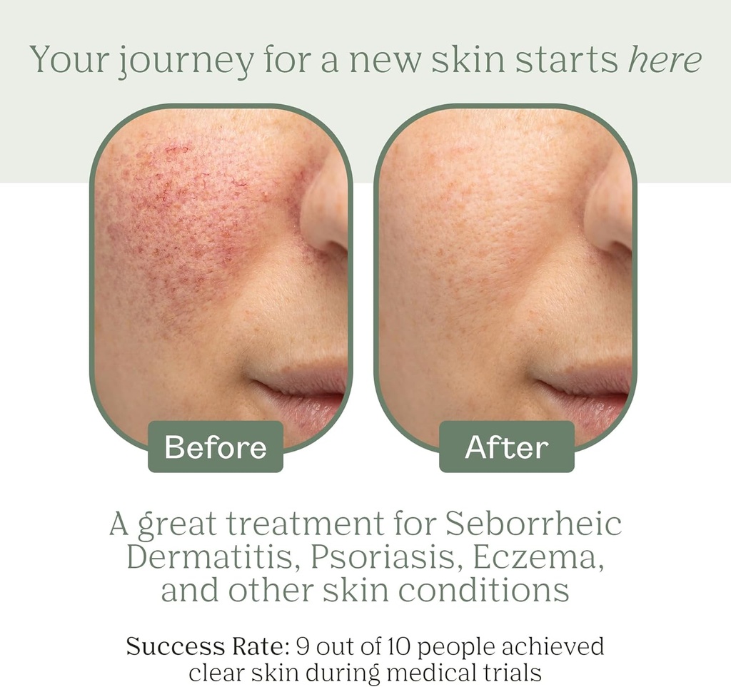 dermabon-seborrheic-dermatitis-cream-ecz-2.jpg