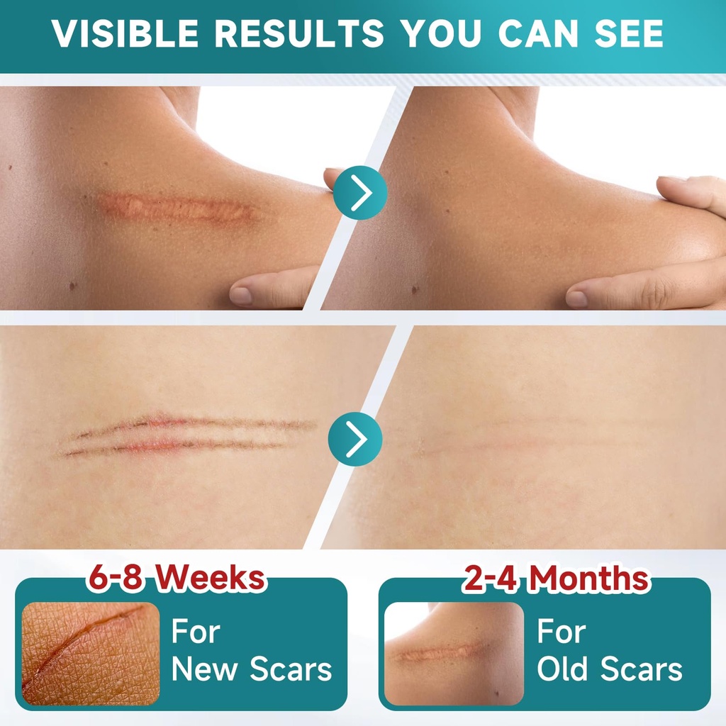 pumkot-silicone-scar-sheets-silicone-sca-2.jpg