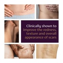 mederma-advanced-scar-gel-treats-old-new-5.jpg