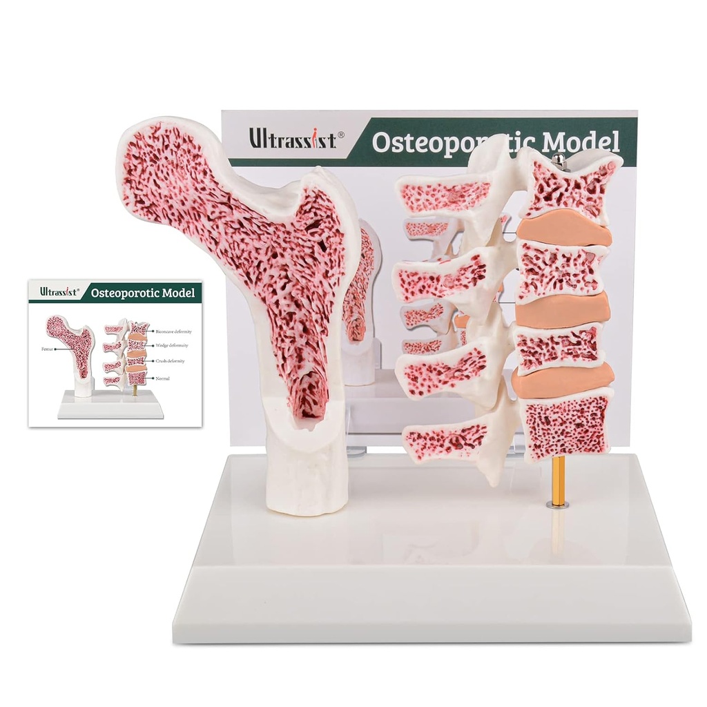 Ultrassist Human Anatomy Osteoporosis Model, Vertebrae Anatomical Skeleton Model med studiekort för medicinsk studentundervisning Demonstration